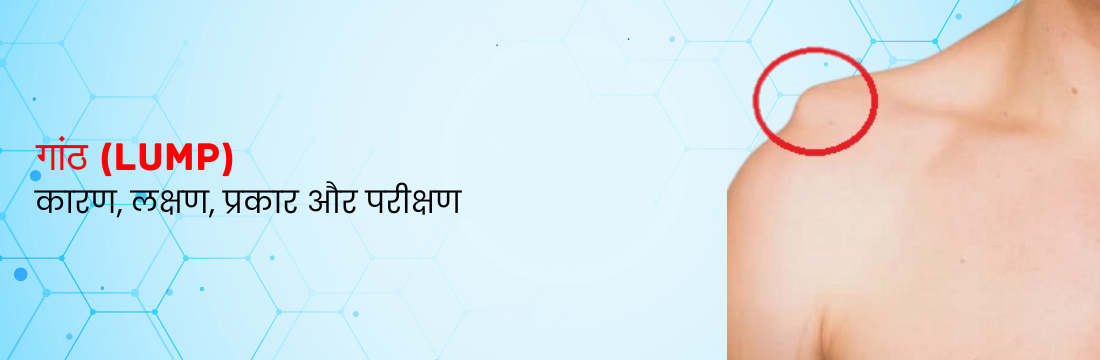 गांठ: कारण, लक्षण, प्रकार और परीक्षण